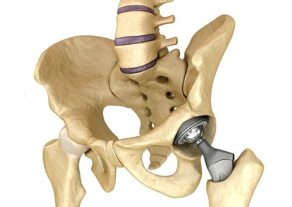 The endoprostetics of the hip joint