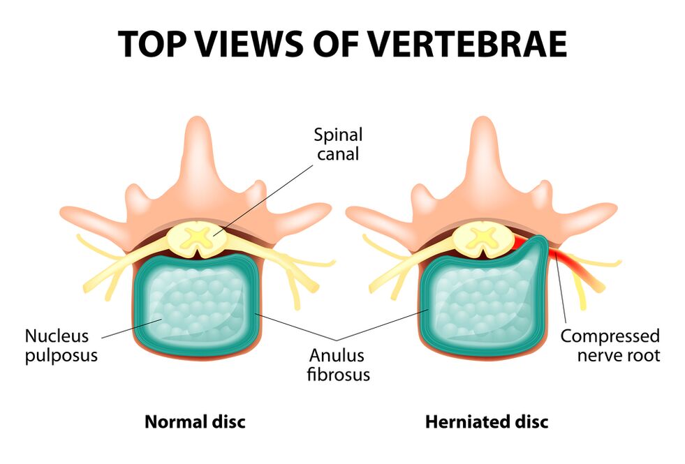 Healthy vertebrae and hernia