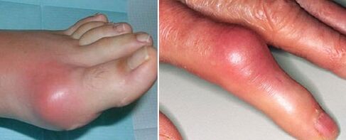 appearance of arthritic joints