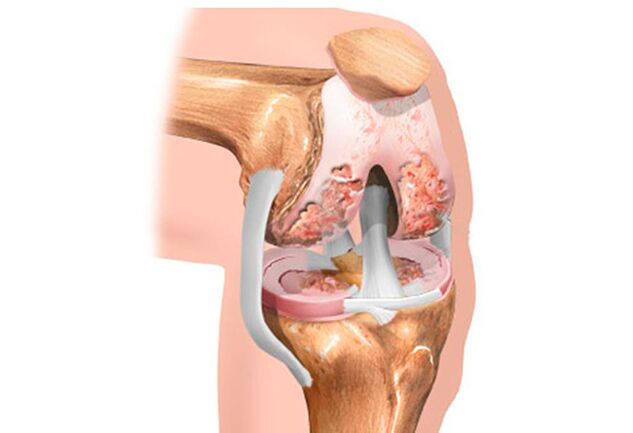 Arthrosis of the knee joint