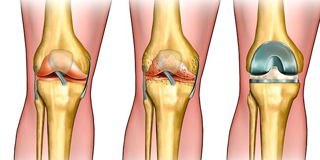 In the third stage of arthrosis, a knee prosthesis is required