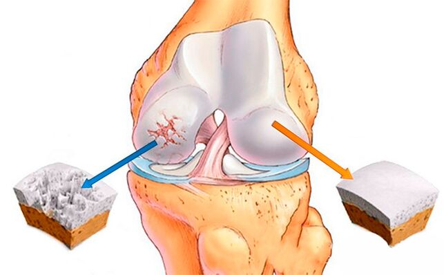Normal knee joint (right) and affected by arthrosis (left)