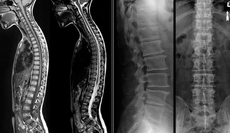 X-rays and MRI images for osteochondrosis