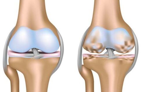 destruction of a healthy joint and knee joint in arthrosis