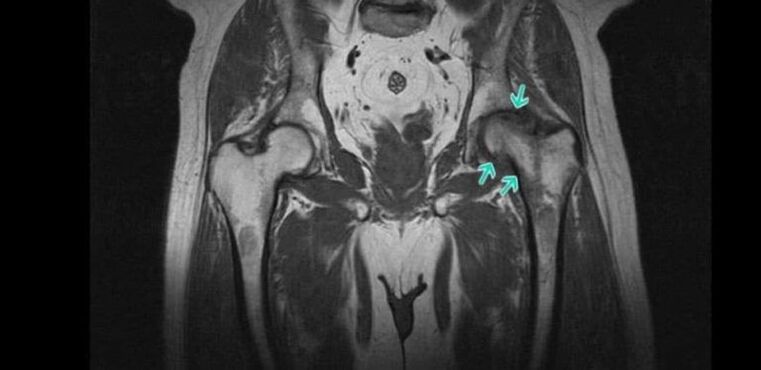 Degenerative-dystrophic changes in the hip joint on MRI