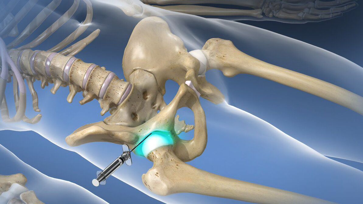 Intra-articular blockade for the elimination of acute pain in coxarthrosis