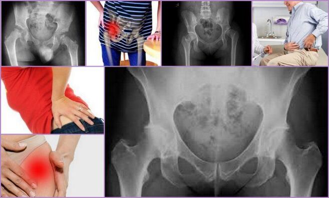 Pain and limited movement are the main symptoms of hip osteoarthritis