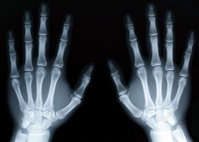 Gout provokes the development of gouty arthritis, which can be diagnosed with X-rays