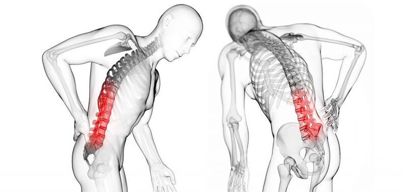 complications caused by cervical osteochondrosis